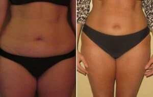 Before and after Vevazz Laser Lipo at Petra's Weight Loss Clinic in Oklahoma City