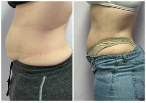 Before and after Body Sculpting at Petra's Weight Loss Clinic in Oklahoma City