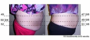 Before and after Vevazz Laser Lipo at Petra's Weight Loss Clinic in Oklahoma City