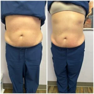 Before and after Body Sculpting at Petra's Weight Loss Clinic in Oklahoma City