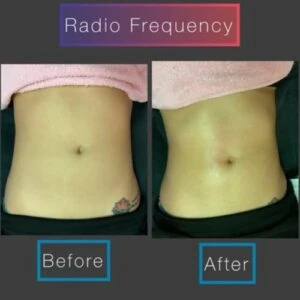 Before and after Body Sculpting at Petra's Weight Loss Clinic in Oklahoma City