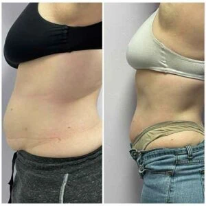 Before and after Body Sculpting at Petra's Weight Loss Clinic in Oklahoma City
