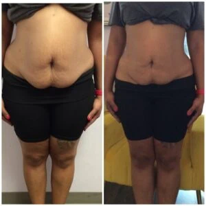 Before and after Vevazz Laser Lipo at Petra's Weight Loss Clinic in Oklahoma City