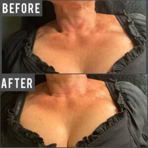 Before and after Body Sculpting at Petra's Weight Loss Clinic in Oklahoma City