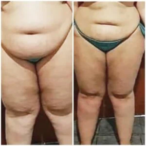 Before and after Fat Freezing at Petra's Weight Loss Clinic in Oklahoma City