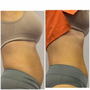 Before and after Body Sculpting at Petra's Weight Loss Clinic in Oklahoma City