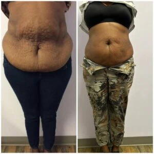 Before and after Fat Freezing at Petra's Weight Loss Clinic in Oklahoma City