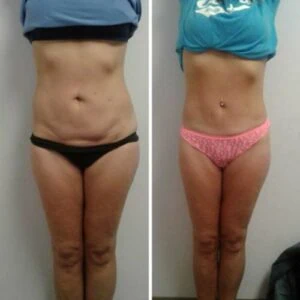 Before and after Body Sculpting at Petra's Weight Loss Clinic in Oklahoma City