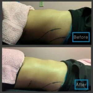 Before and after Body Sculpting at Petra's Weight Loss Clinic in Oklahoma City