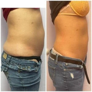Before and after Body Sculpting at Petra's Weight Loss Clinic in Oklahoma City