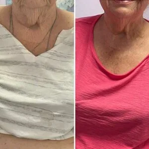 Before and after Vevazz Laser Lipo at Petra's Weight Loss Clinic in Oklahoma City