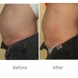 Before and after Body Shape at Petra's Weight Loss Clinic in Oklahoma City