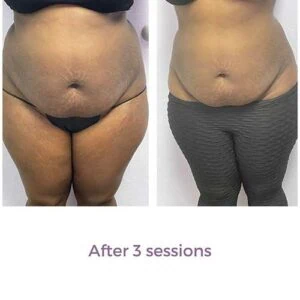 Before and after Vevazz Laser Lipo at Petra's Weight Loss Clinic in Oklahoma City