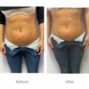 Before and after Body Sculpting at Petra's Weight Loss Clinic in Oklahoma City