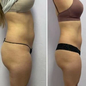 Before and after Body Sculpting at Petra's Weight Loss Clinic in Oklahoma City