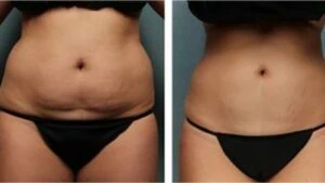 Before and after Liposlim at Petra's Weight Loss Clinic in Oklahoma City