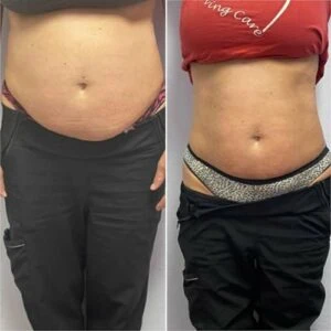Before and after Body Sculpting at Petra's Weight Loss Clinic in Oklahoma City