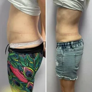 Before and after Body Sculpting at Petra's Weight Loss Clinic in Oklahoma City