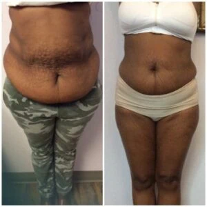 Before and after Fat Freezing at Petra's Weight Loss Clinic in Oklahoma City