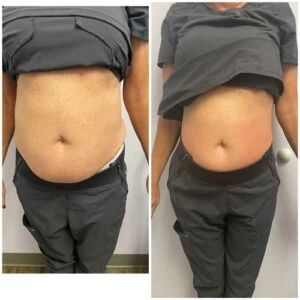 Before and after Body Shape at Petra's Weight Loss Clinic in Oklahoma City