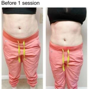 Before and after Body Sculpting at Petra's Weight Loss Clinic in Oklahoma City