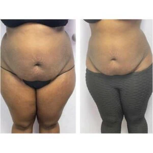 Before and after Body Sculpting at Petra's Weight Loss Clinic in Oklahoma City