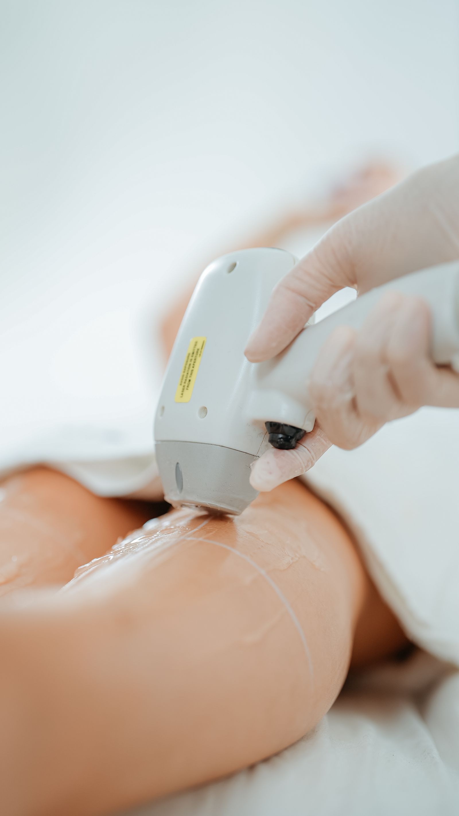 IPL Laser Hair Removal treatment at Petra's Weight Loss Clinic