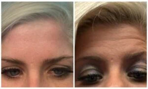 Before and after Vevazz Laser Lipo at Petra's Weight Loss Clinic in Oklahoma City