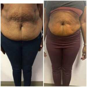 Before and after Fat Freezing at Petra's Weight Loss Clinic in Oklahoma City