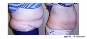 Before and after Vevazz Laser Lipo at Petra's Weight Loss Clinic in Oklahoma City