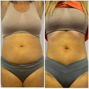 Before and after Body Sculpting at Petra's Weight Loss Clinic in Oklahoma City