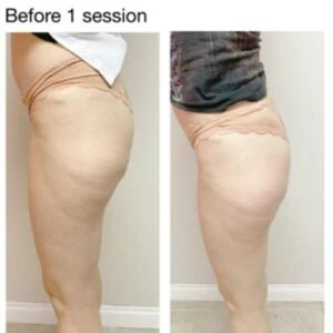 Before and after Body Sculpting at Petra's Weight Loss Clinic in Oklahoma City