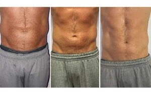 Before and after Body Sculpting at Petra's Weight Loss Clinic in Oklahoma City