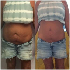Before and after Liposlim at Petra's Weight Loss Clinic in Oklahoma City