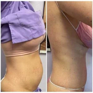 Before and after Body Sculpting at Petra's Weight Loss Clinic in Oklahoma City
