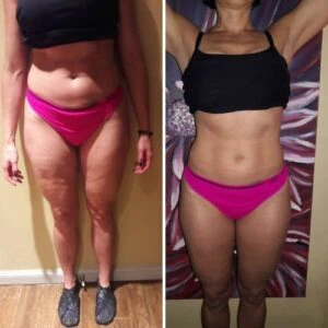 Before and after Vevazz Laser Lipo at Petra's Weight Loss Clinic in Oklahoma City
