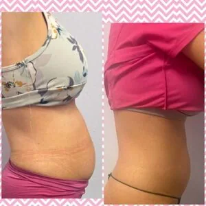Before and after Body Sculpting at Petra's Weight Loss Clinic in Oklahoma City