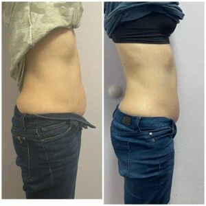 Before and after Body Sculpting at Petra's Weight Loss Clinic in Oklahoma City