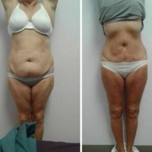 Before and after Body Sculpting at Petra's Weight Loss Clinic in Oklahoma City