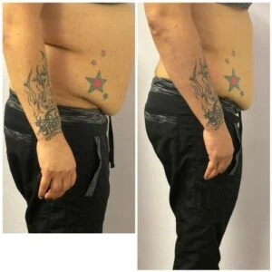 Before and after Fat Freezing at Petra's Weight Loss Clinic in Oklahoma City