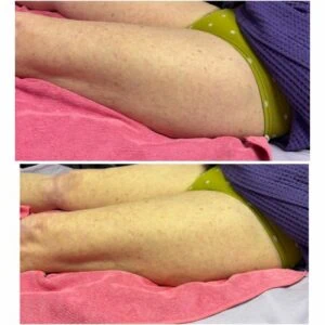 Before and after Body Sculpting at Petra's Weight Loss Clinic in Oklahoma City