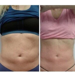 Before and after Body Sculpting at Petra's Weight Loss Clinic in Oklahoma City