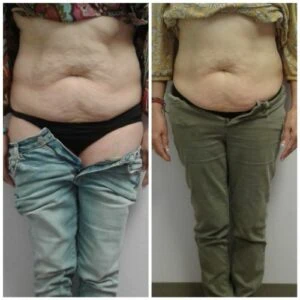Before and after Body Sculpting at Petra's Weight Loss Clinic in Oklahoma City