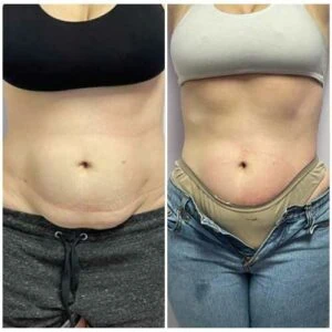 Before and after Body Sculpting at Petra's Weight Loss Clinic in Oklahoma City