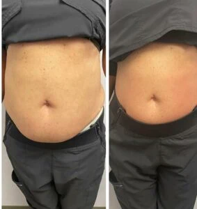 Before and after Body Shape at Petra's Weight Loss Clinic in Oklahoma City