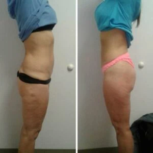 Before and after Body Sculpting at Petra's Weight Loss Clinic in Oklahoma City