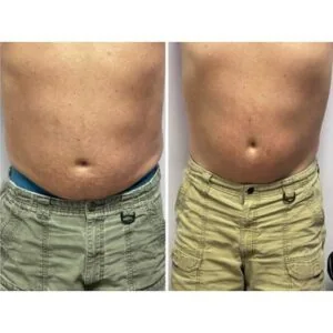 Before and after Body Sculpting at Petra's Weight Loss Clinic in Oklahoma City