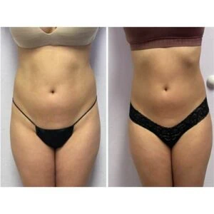 Before and after Body Sculpting at Petra's Weight Loss Clinic in Oklahoma City
