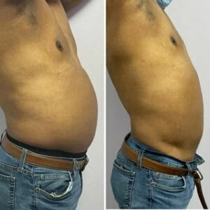 Before and after Body Sculpting at Petra's Weight Loss Clinic in Oklahoma City
