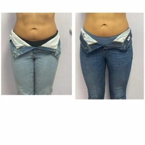 Before and after Body Sculpting at Petra's Weight Loss Clinic in Oklahoma City